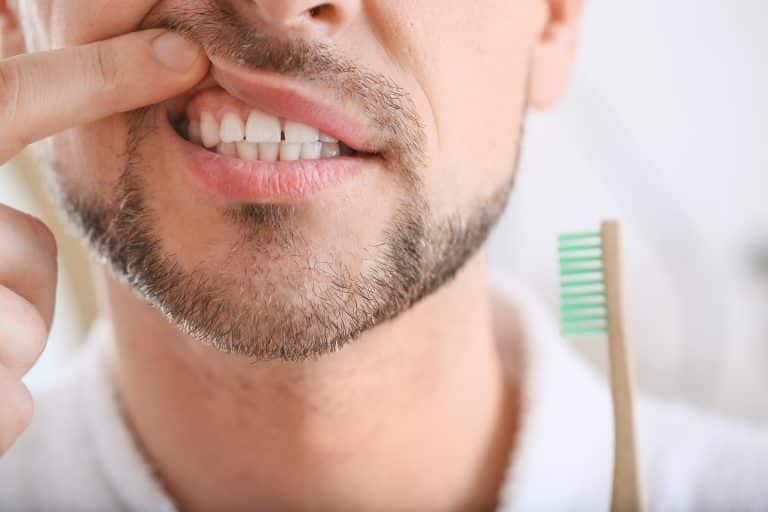 gingivitis