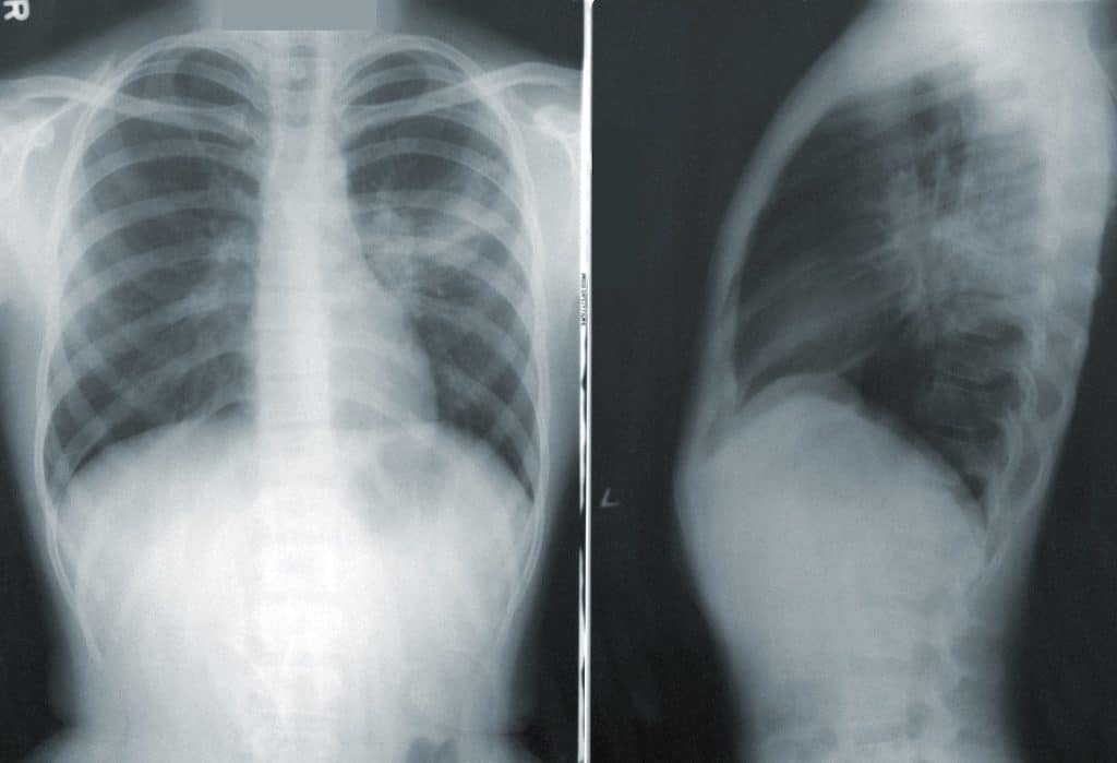 Kronična opstruktivna plućna bolest – uzrok, simptomi, liječenje